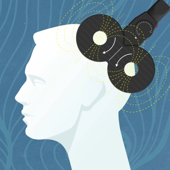 TMS Treatment for Depression
