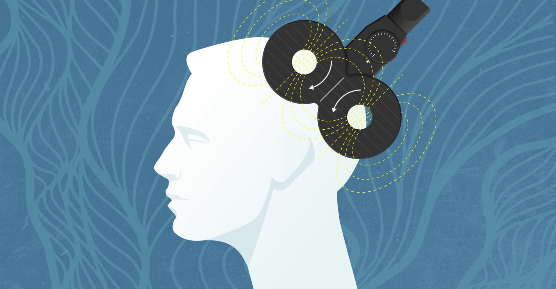 TMS Treatment for Depression