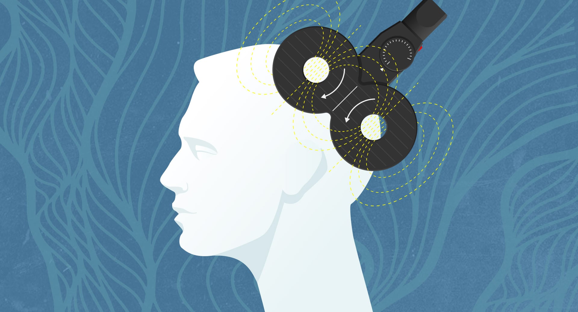 TMS Treatment for Depression